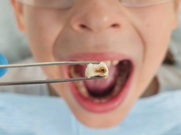 Best Emergency Dental Extractions in Osceola, WI